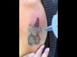 Laser Tattoo Removal Clinic - Unwanted Tattoos